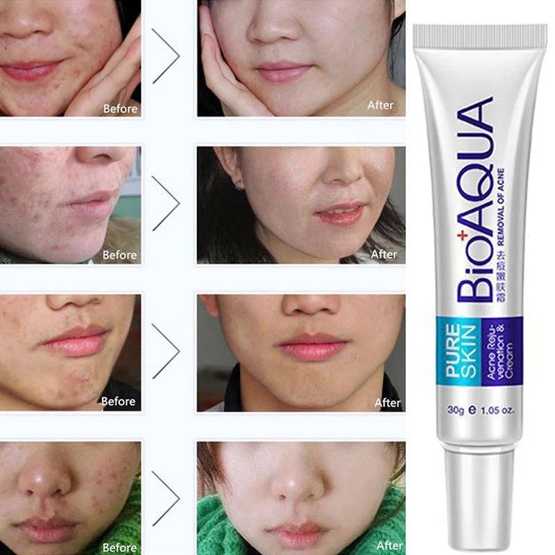 BIOAQUA Acne Scar Removal Rejuvenation Cream, 30 ML